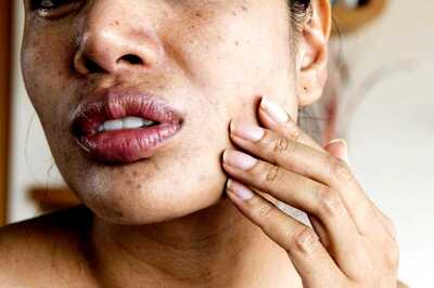 Atopic Dermatitis: All You Need to Know About the Skin Disease, and How it Affects Mental Health