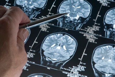 Smartwatches May Detect Parkinson’s 7 Years Before Symptoms Appear