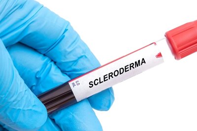 Understanding Scleroderma: The Autoimmune Disorder Tightening Skin and Affecting Organs