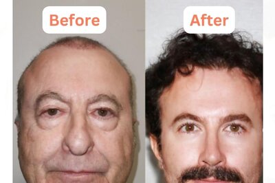 Turkish People are Turning '30 Years Younger' With Jaw-dropping Surgery and Internet is in Disbelief