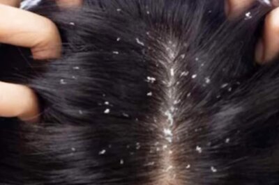 Avarampoo: The Ayurvedic Wonder Flower With Multiple Health Benefits