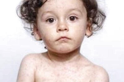 All You Need To Know About Measles And Things To Keep In Mind