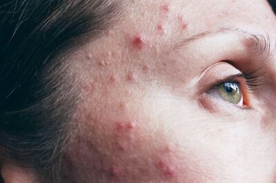 How to Cure Pimples at Home; Expert Weighs In