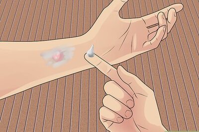 How to Lance and Drain a Blister