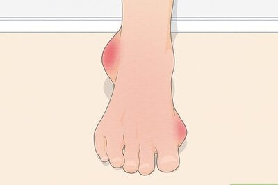 How to Treat Gout