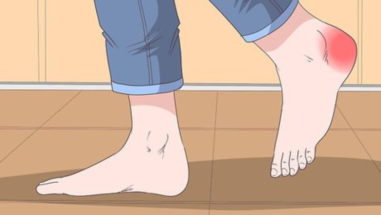 How to Treat a Heel Bruise