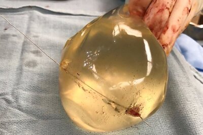 National Plastic Surgery Day 2020: 7 Myths About Breast Implants