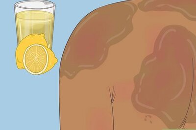 How to Remove Sunburn Patches (for Indian Skin Types)