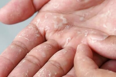 Excessive Washing To Infection, 5 Causes Of Skin Peeling On Hands