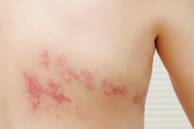 Follow These Home Remedies For Prevention Of Shingles