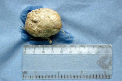 India's Biggest Bladder Stone Weighing 1.4 kg Removed: Doctor