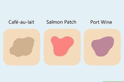 How to Lighten Birthmarks: Can Natural Remedies Help?