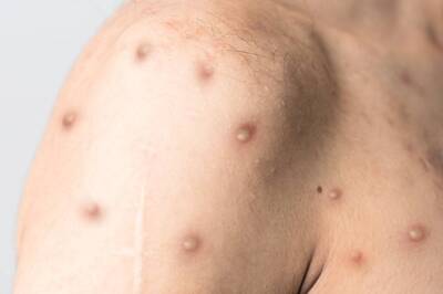 Monkeypox Outbreak: Researchers In 2021 Conducted Table-Top Simulation Which Predicted Exact Date Of Outbreak