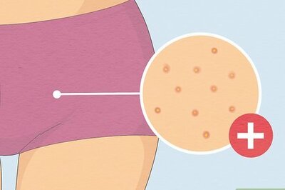 How to Get Rid of Fordyce Spots