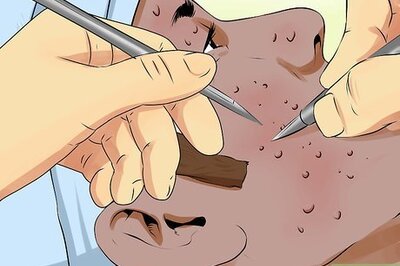 How to Treat Chicken Pox Scars