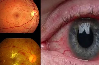 Diabetic Retinopathy: Everything You Should Know