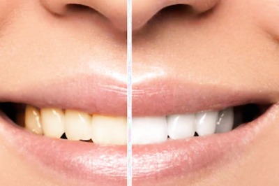 6 Different Cosmetic Dentistry Procedures And Their Benefits