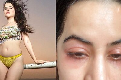 Urfi Javed Shares Photo Of Swollen Face, Claims It's Allergies: 'Getting Fillers, Botox Since I Was 18'