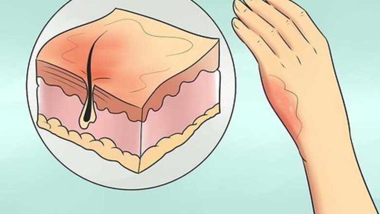 How to Treat Minor Burns