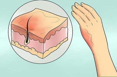 How to Treat Minor Burns