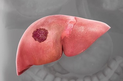 High Cholesterol May Cause Liver Cancer: Beware Of These Symptoms