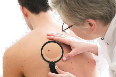The number of moles on a person's right arm could indicate skin cancer risk