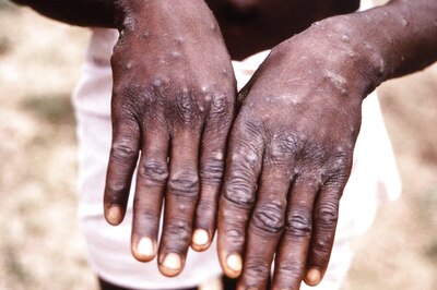 Monkeypox Declared Global Health Emergency by WHO as Cases Surge | A Complete Guide Here