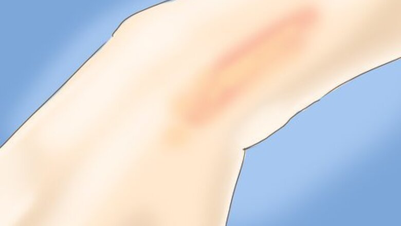 How to Cure a Small Bad Burn