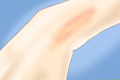 How to Cure a Small Bad Burn