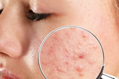 Adding Probiotics To Avoiding Processed Foods, Dietary Habits For Acne Free Skin