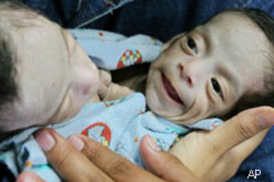 Conjoined twins separated in Guatemala