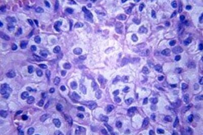 Scientists create cancer-killing fungus