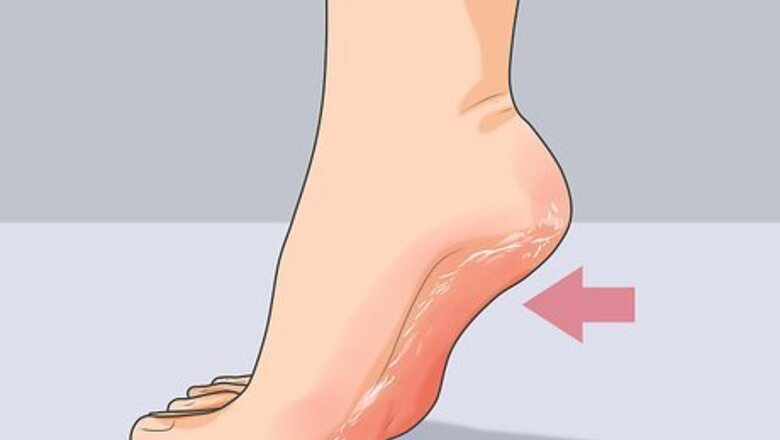 How to Get Rid of Cracked Heels Fast