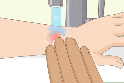 How to Treat a Wasp Sting on a Child