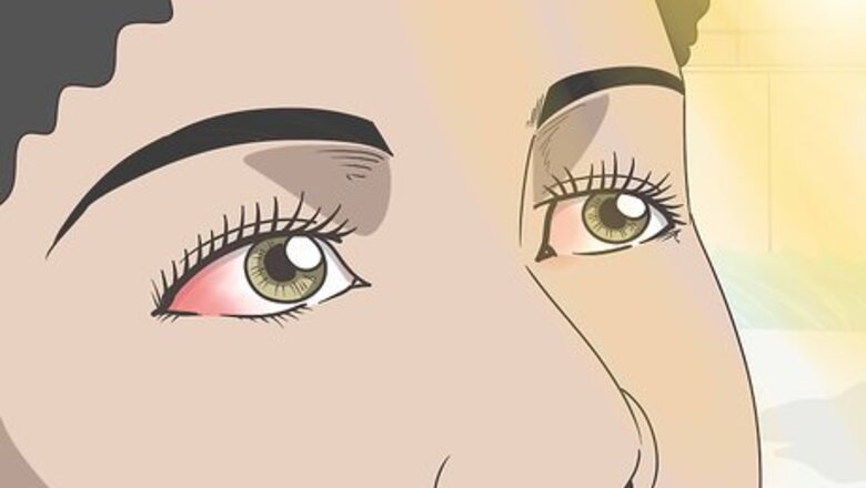 How to Treat Sunburned Eyes