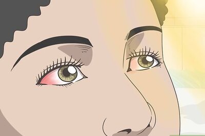 How to Treat Sunburned Eyes