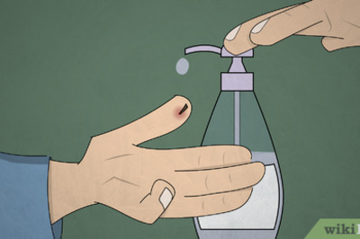 How to Get a Splinter Out