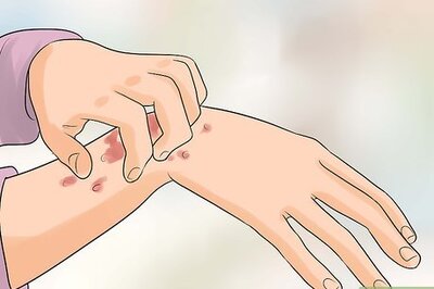 How to Identify and Manage an HIV Rash